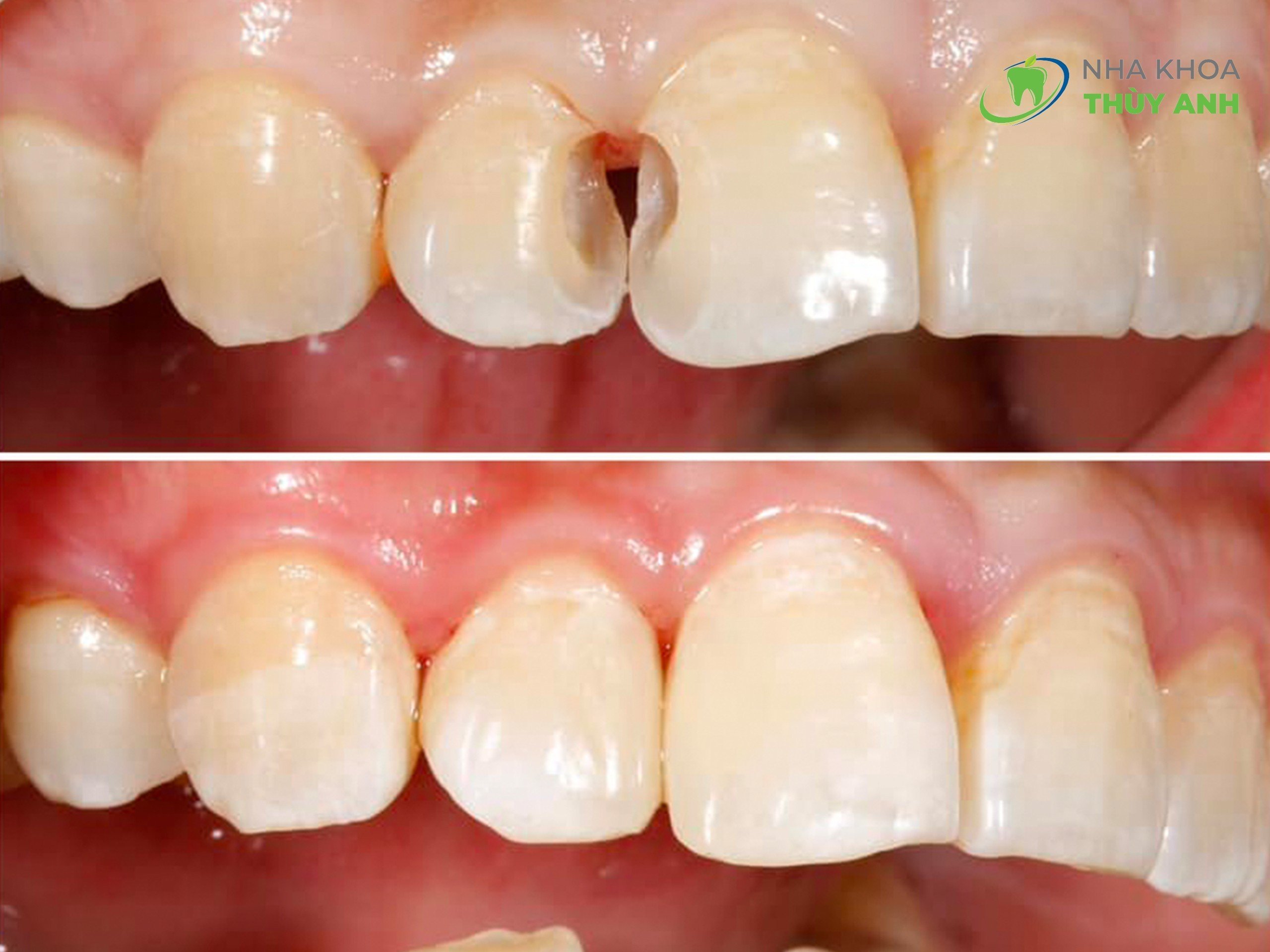 Trám răng Inlay/ onlay / overlay là gì? Ưu, nhược điểm của phương pháp ...