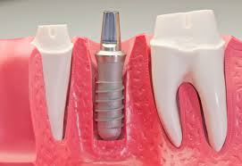 CẤY GHÉP IMPLANT CHÂN RĂNG NHÂN TẠO UY TÍN NHẤT THÁI NGUYÊN