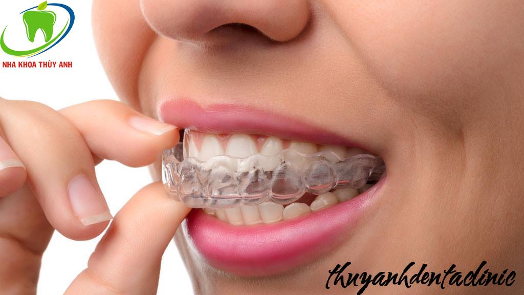 NIỀNG RĂNG KHÔNG MẮC CÀI INVISALIGN