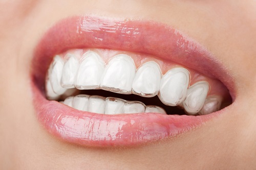 NẮN CHỈNH RĂNG BẰNG MẮC CÀI TRẢ GÓP, UY TÍN NHẤT THÁI NGUYÊN